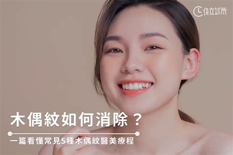 法令紋 木偶紋|木偶紋如何消除？一篇看懂常見5種木偶紋醫美療程